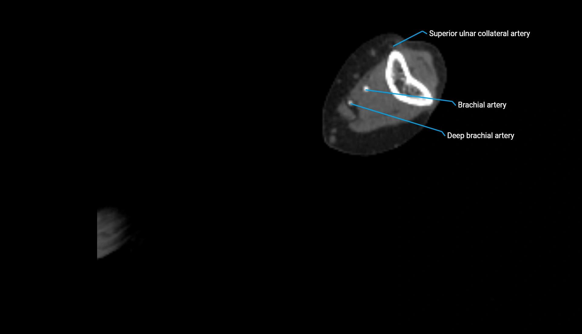 CTA upper limb axial cross sectional anatomy labelled image 201 (2).webp